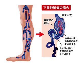 北千住静脈瘤クリニック | 下肢静脈瘤治療の外科クリニック